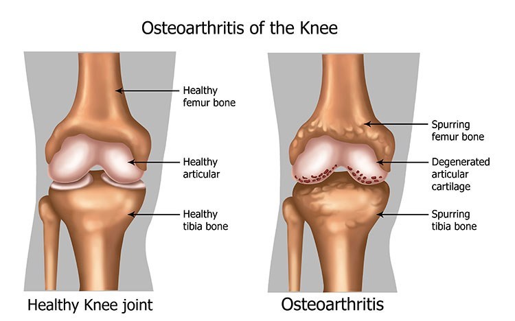 Osteoarthritis Pain Relief In Jacksonville , FL - Jacksonville Acupuncture Clinic