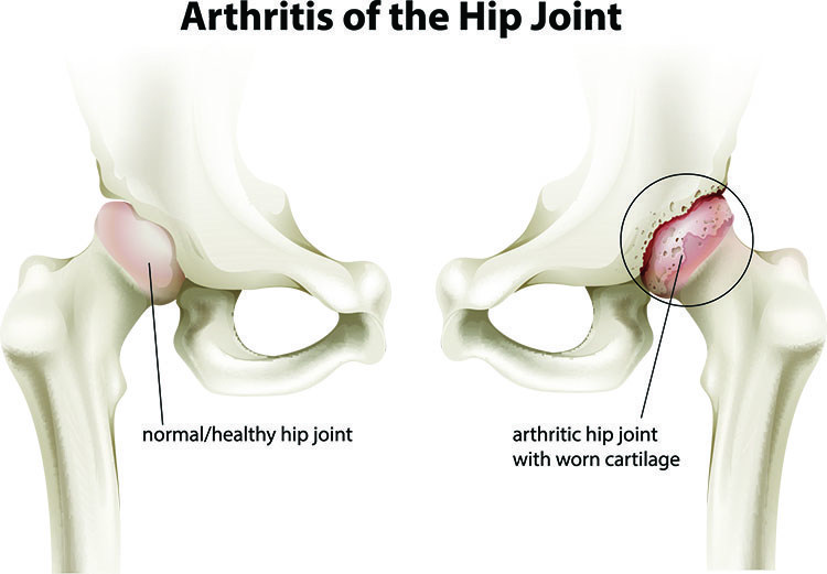 Arthritis Pain Relief In Jacksonville , FL - Jacksonville Acupuncture Clinic