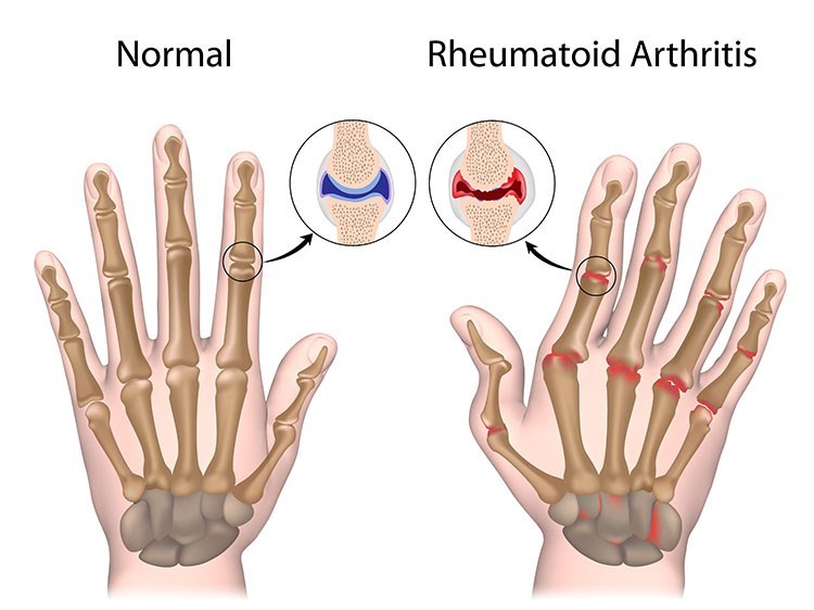 Rheumatoid Arthritis Pain Relief In Jacksonville , FL - Jacksonville Acupuncture Clinic