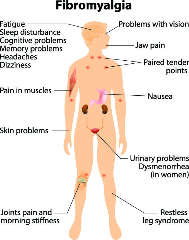 Fibromyalgia Natural Treatment With Chinese Medicine - Jacksonville Acupuncture Clinic